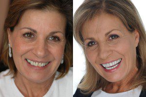 Faccette Dentali, Prima e Dopo