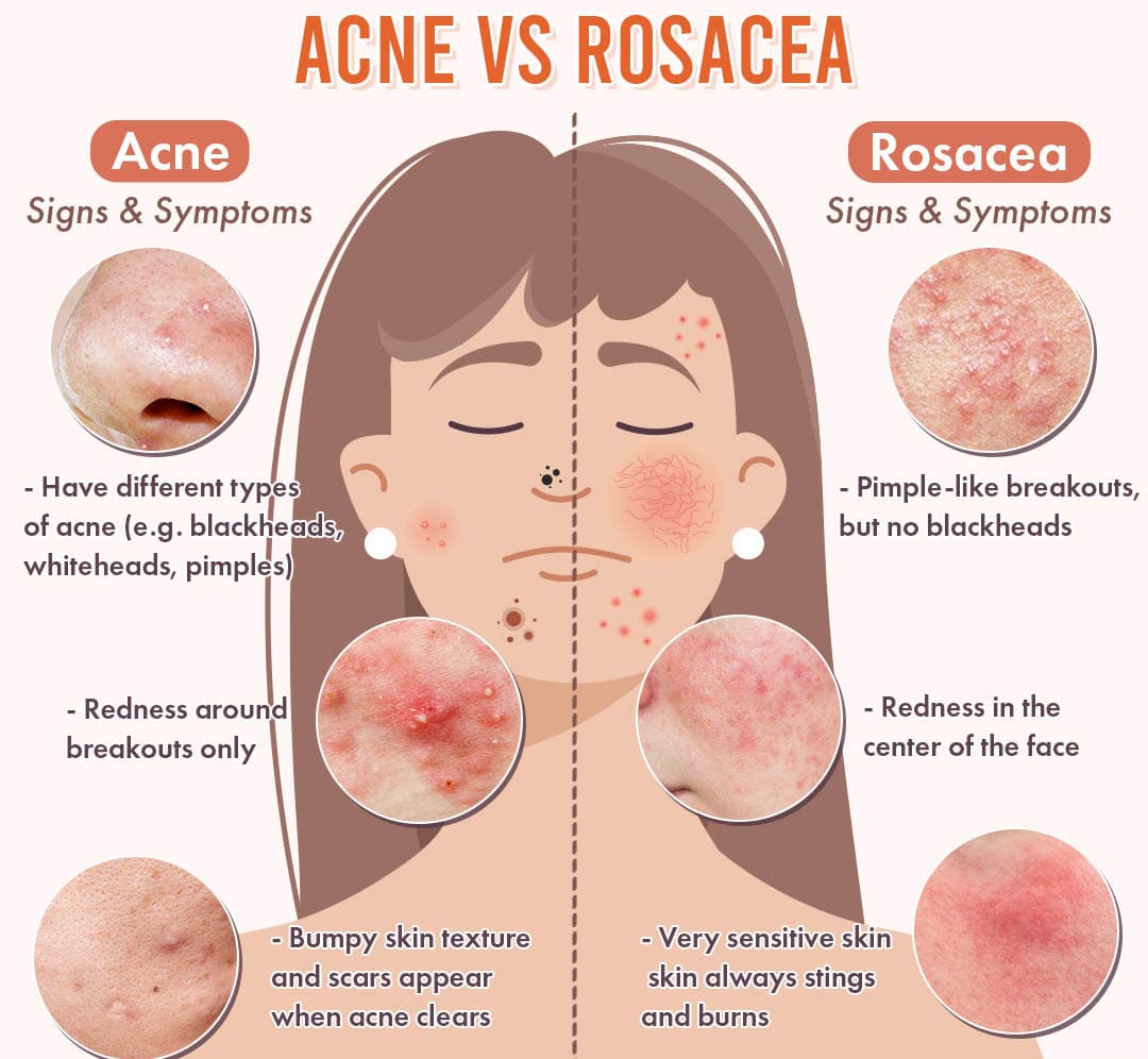 acne vs rosacea