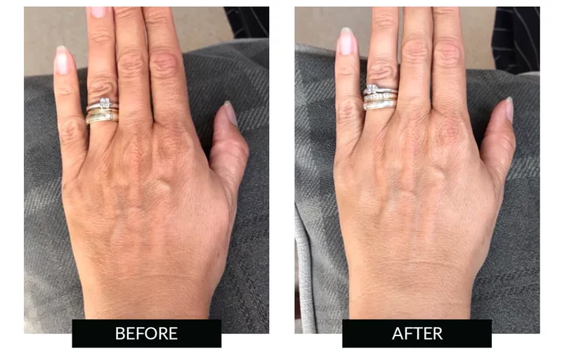 prima e dopo trattamento mani luce LED